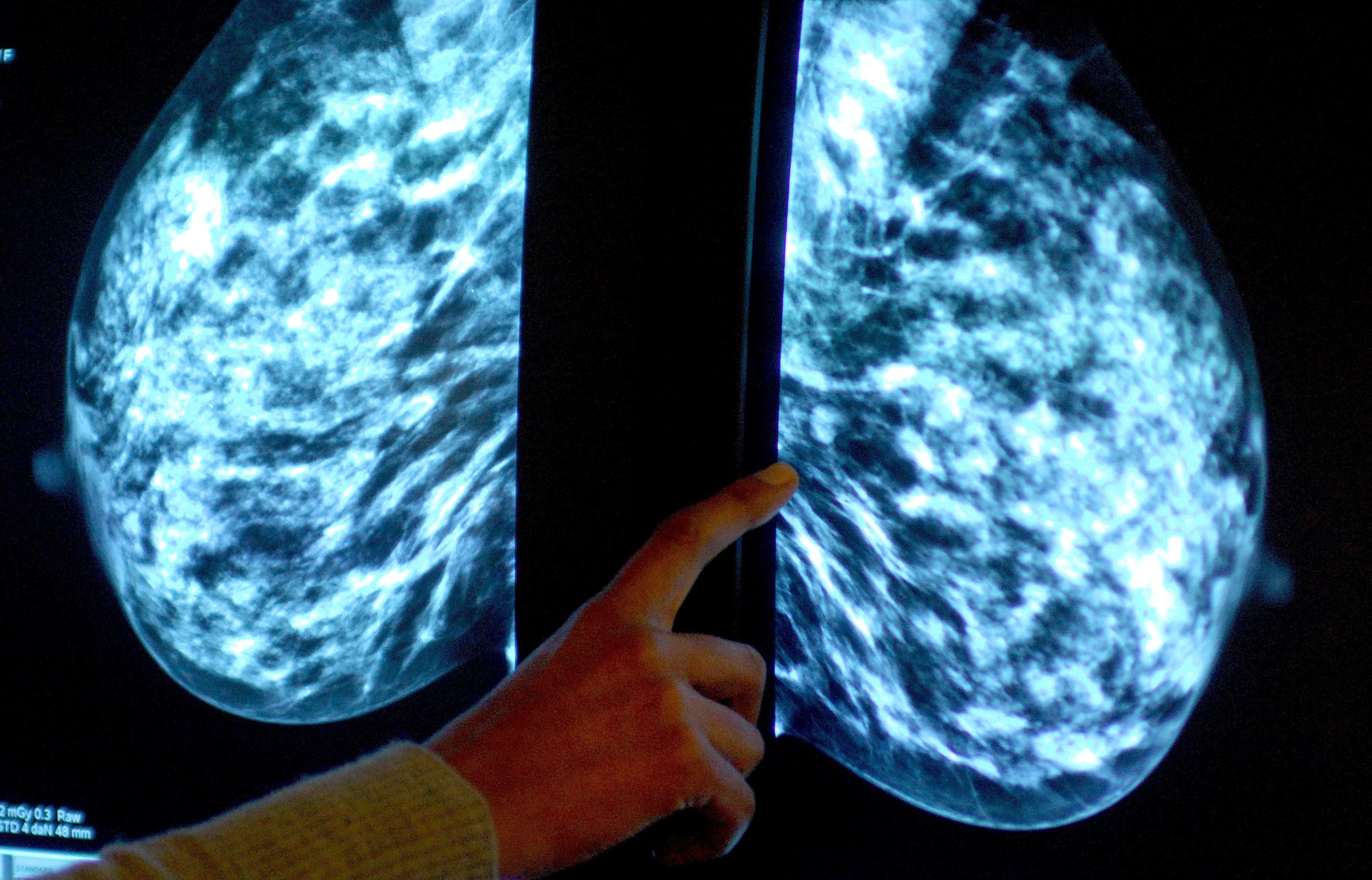 Breast screening uptake in Devon remains below pre-pandemic levels