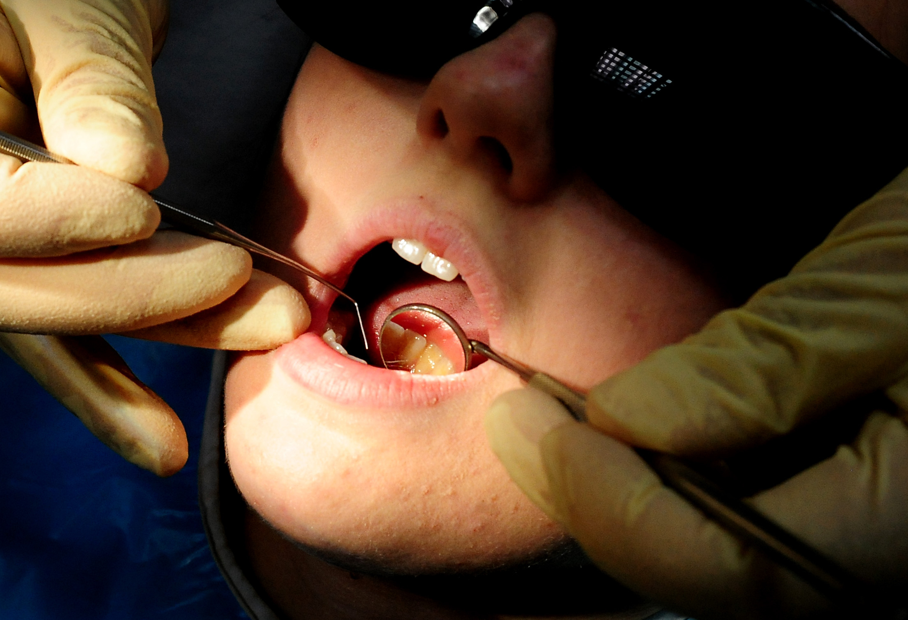 Dozens of hospital admissions in Mid Devon to remove children's rotten teeth